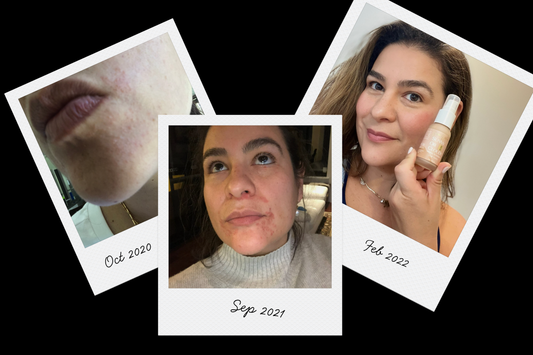 How I Manage My Perioral Dermatitis